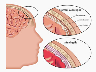 apa-itu-meningitis